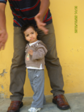 "Baby Burton," born with multiple birth defects