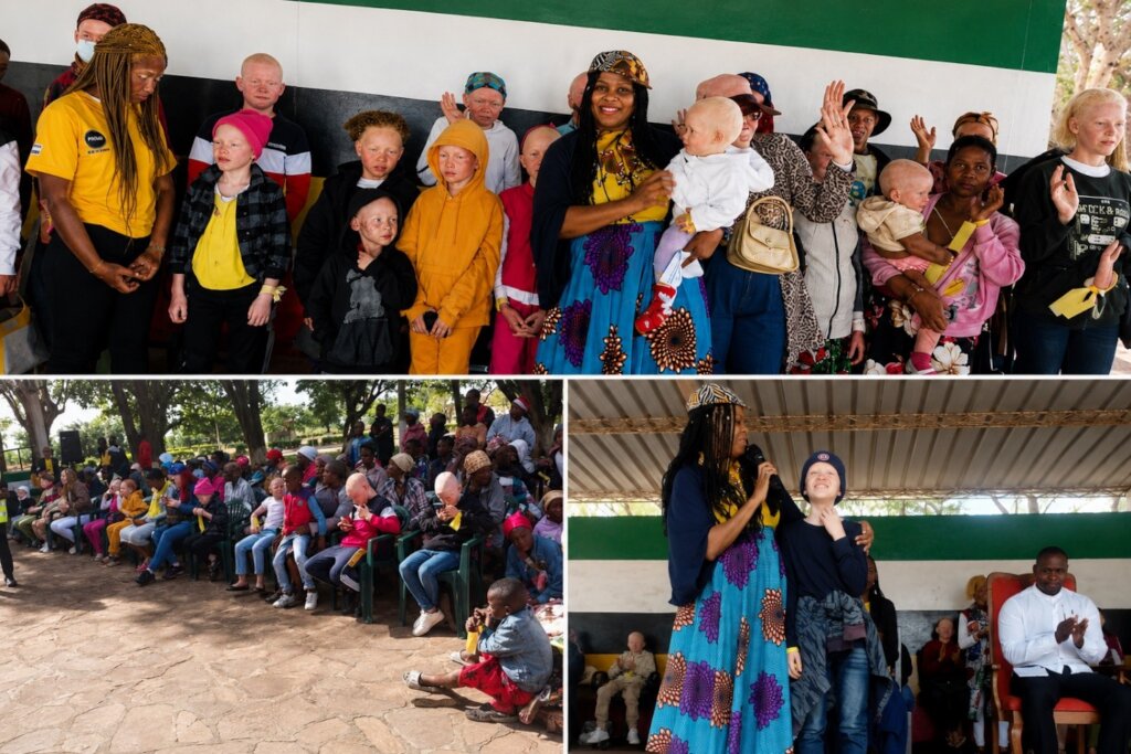 Advance Inclusion for People with Albinism