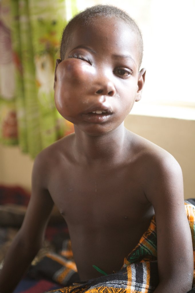 Improve cancer care for 250 children in Malawi