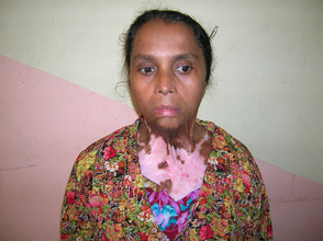 Burn Unit Patient