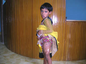 Pediatric Burn Victim Patient @ Health Complex