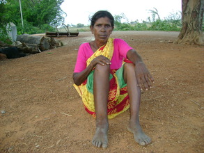 B. Subbamma, Filariasis patient