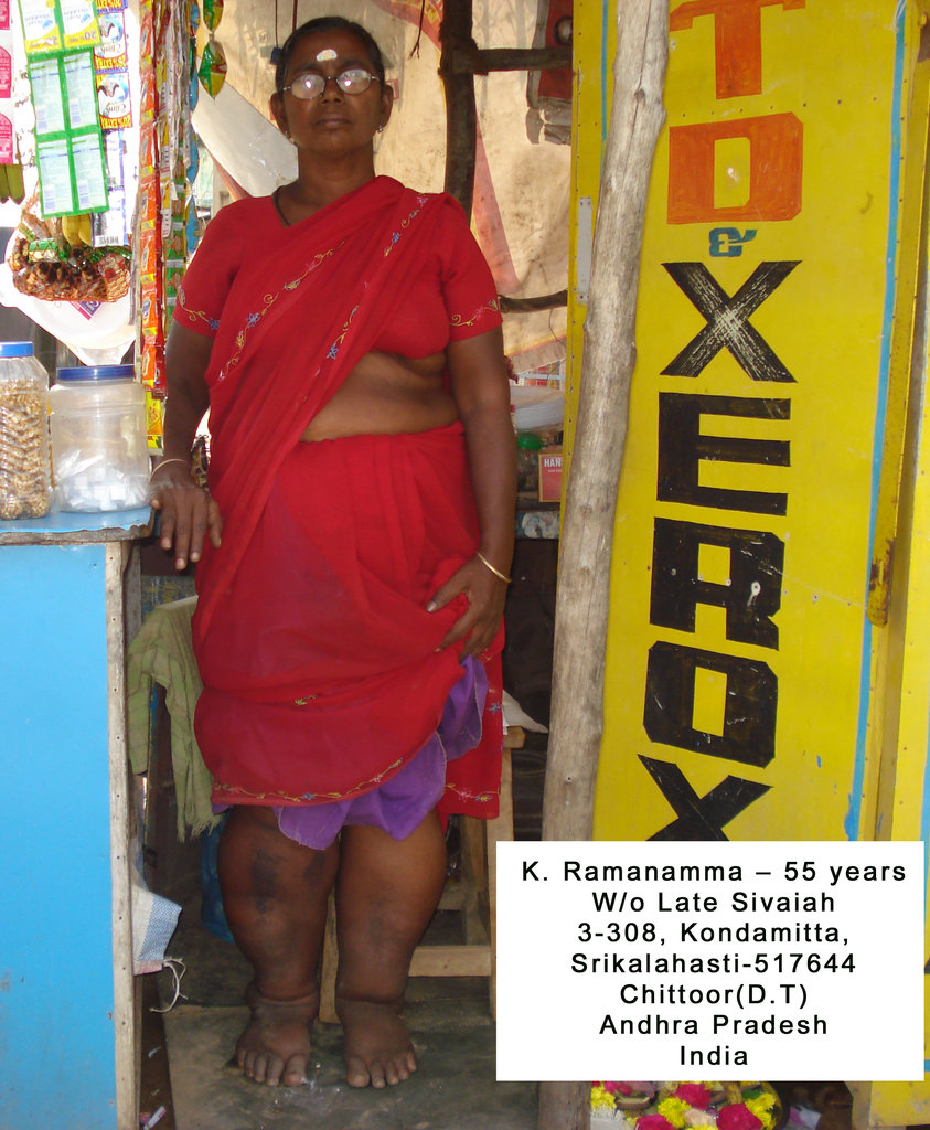 Mrs.K. Ramanamma LF patient