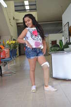 Juliana showing off her new leg!