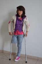Sara before getting her new prostheses