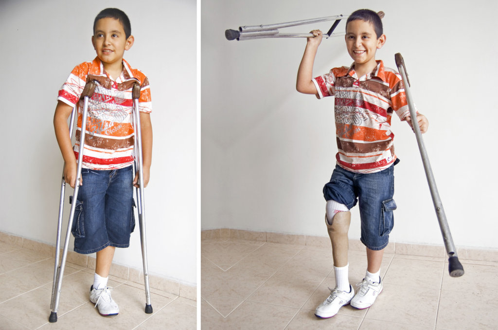 Give prosthetics to low limbs amputees in Colombia
