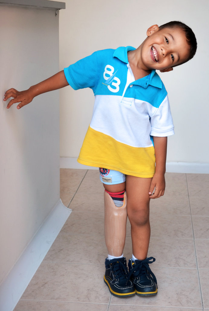 Give prosthetics to low limbs amputees in Colombia