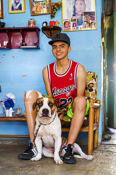 Give prosthetics to low limbs amputees in Colombia