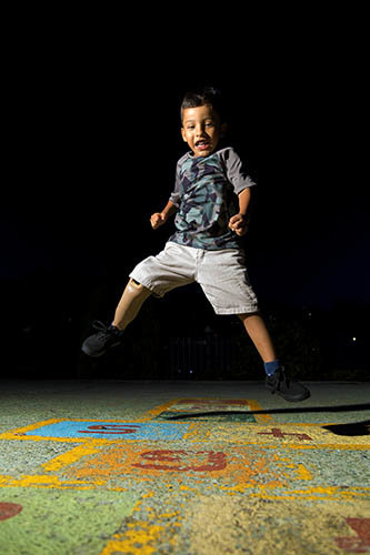 Give prosthetics to low limbs amputees in Colombia