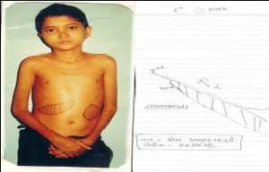 Sickle_cell_patient