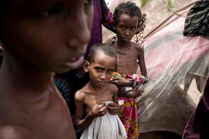 Severely malnourished children await aid.