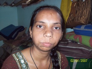 Rehana - before surgery