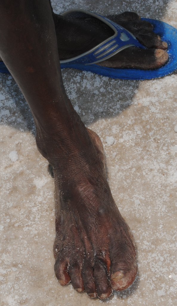 Enhance health of 900 SaltPan Women in South India