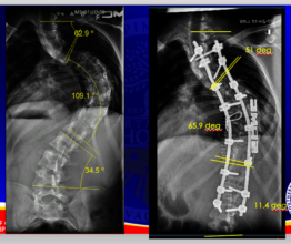 before and after X-rays (frontal)