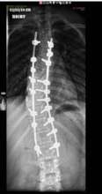 post-op xray