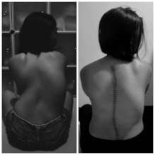 Dwaine's back pre- and post-surgery (Philippines)