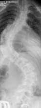 Dwaine's spine x-ray before surgery (Philippines)