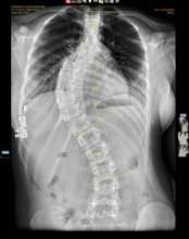 pre-op xray