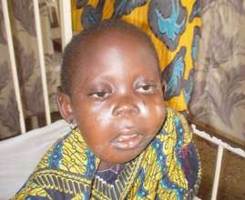 Child with BL prior to treatment