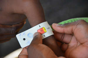 A child is measured for severe acute malnutrition