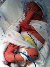 Baby Kiki, born with club foot