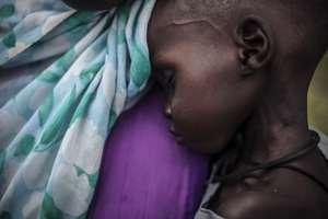 Two year-old Hassan suffers from malnutrition.