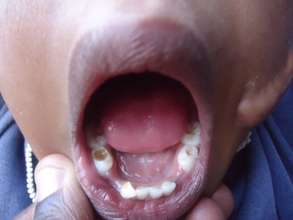 Child in need of dental care